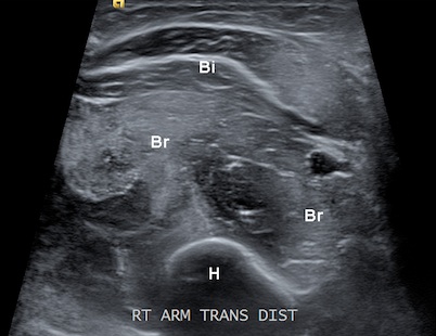 Figure 3 for case Acute rhabdomyolysis